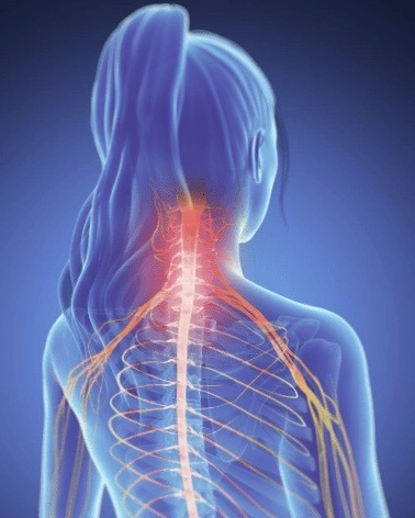 3D imagery showing sources of back and neck pain on the central nervous system.