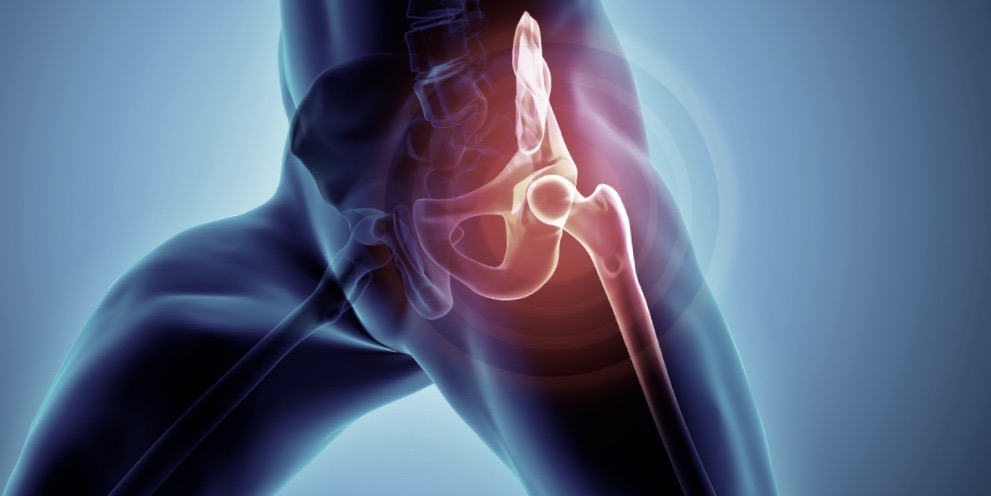 3D imagery showing source of hip pain